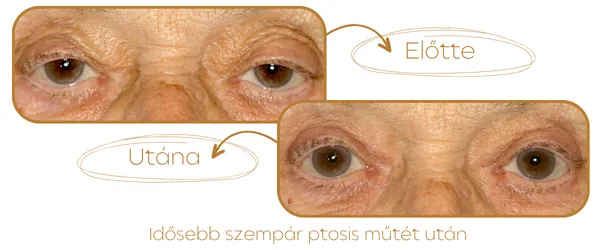 Ptosis műtét - szemhéjcsüngés, szemhéj műtétek - szemhéjplasztika - plasztikai sebész által végzett szemészeti műtét