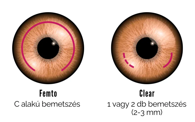 Ziemer Femto LDV Z8 lézer - Clear - lézeres látásjavítás - ReLEx SMILE - SIKK Smartsight - KLEx - cut shape