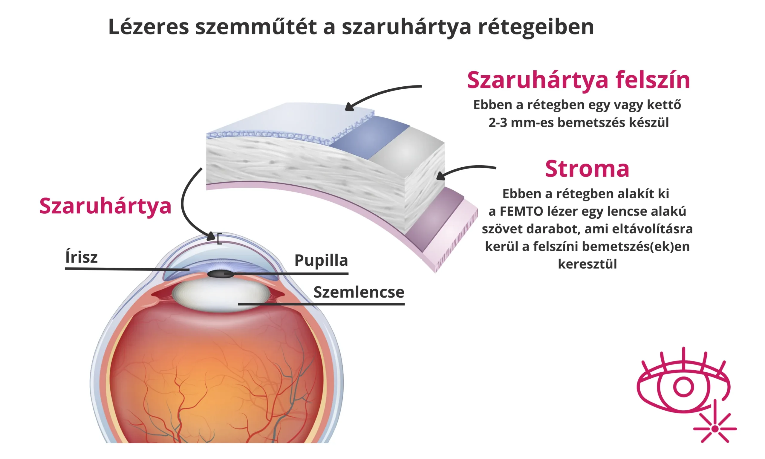 Lézeres szemműtét - lézeres látásjavítás - szaruhártya - stroma - ReLEx SMILE - SIKK Smartsight - KLEx - Clear - FEMTO