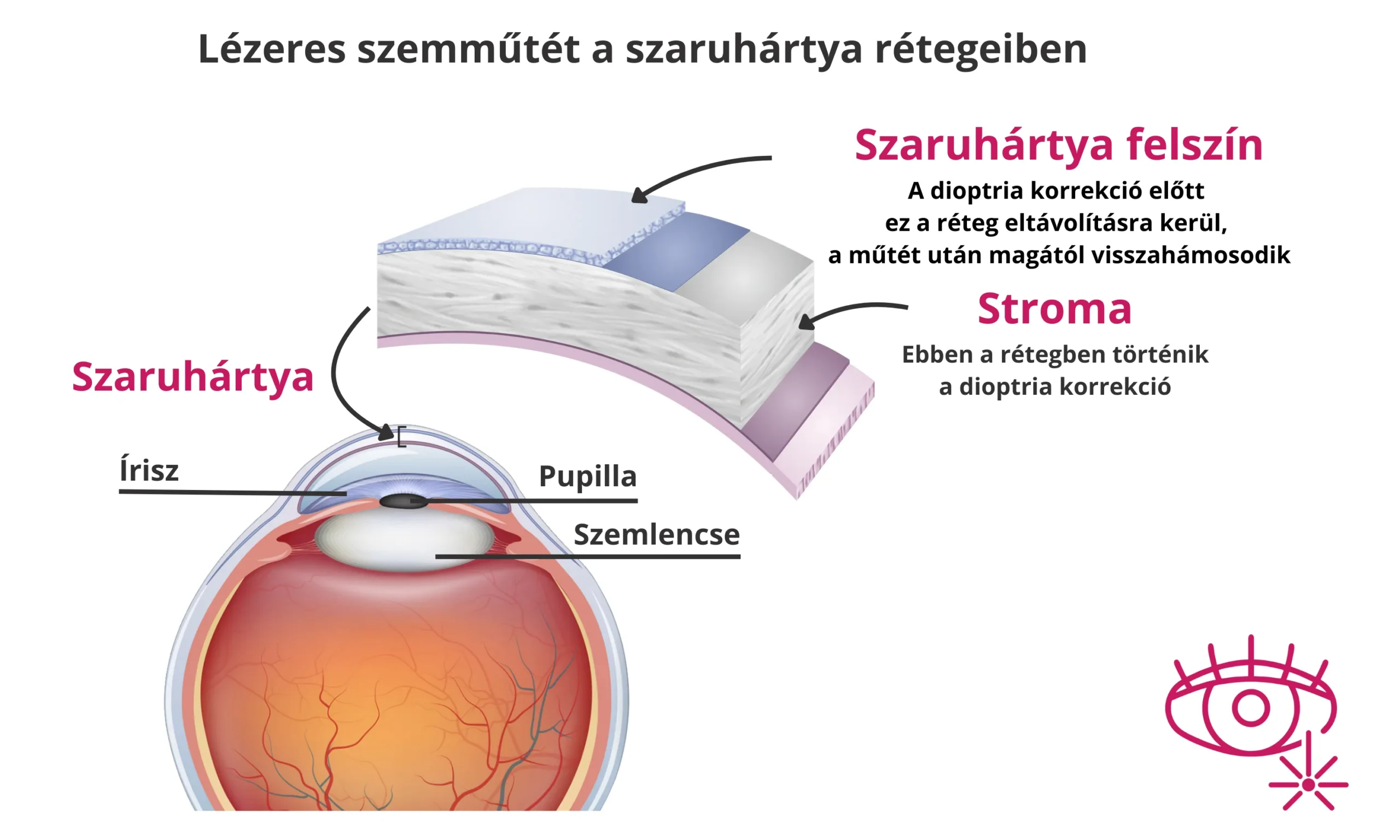 Lézeres szemműtét - lézeres látásjavítás - szaruhártya - stroma - PRK - ZeroTouch - TransPRK