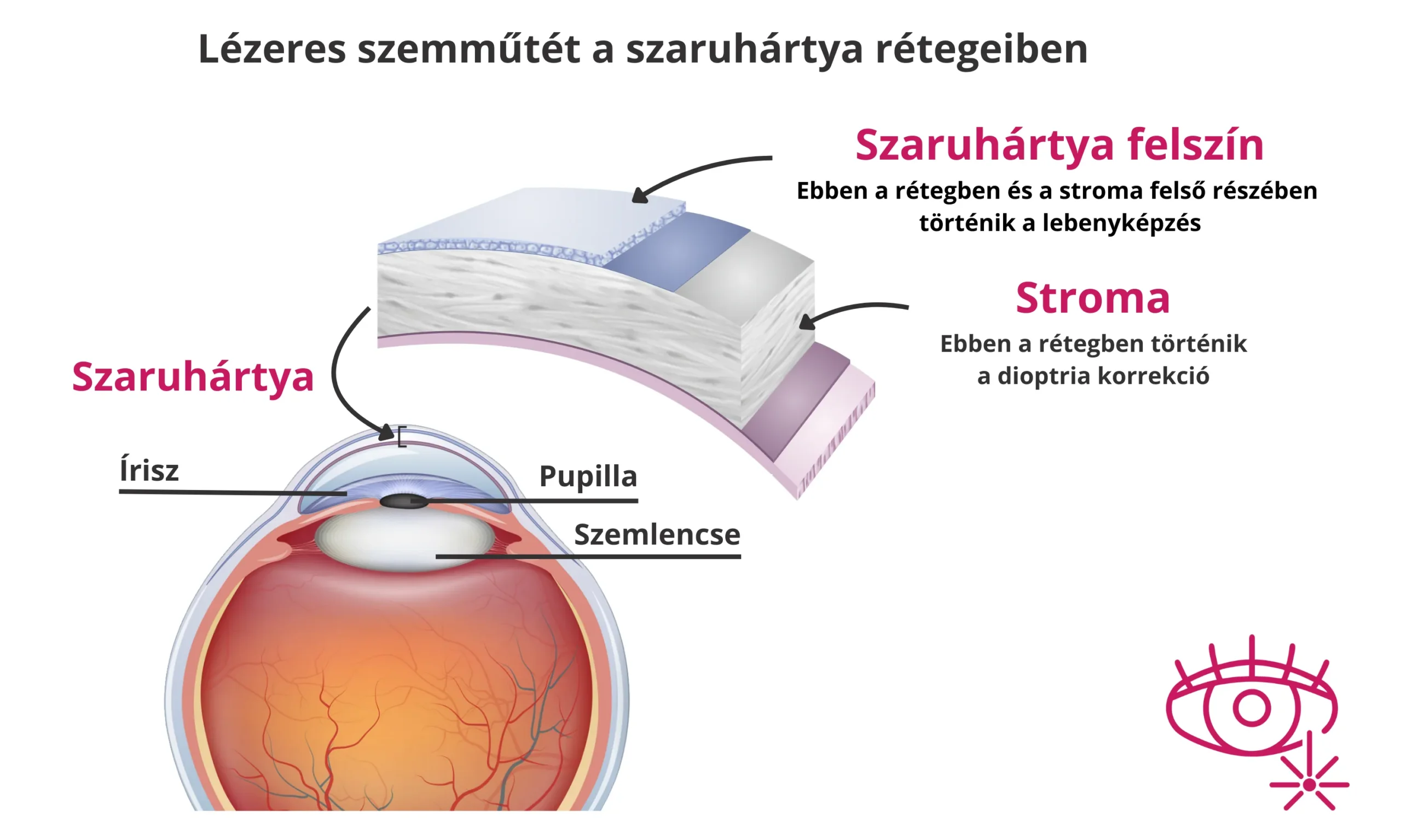 Lézeres szemműtét - lézeres látásjavítás - szaruhártya - stroma - FEMTO - LASIK - OptiLASIK - lebenyes műtét