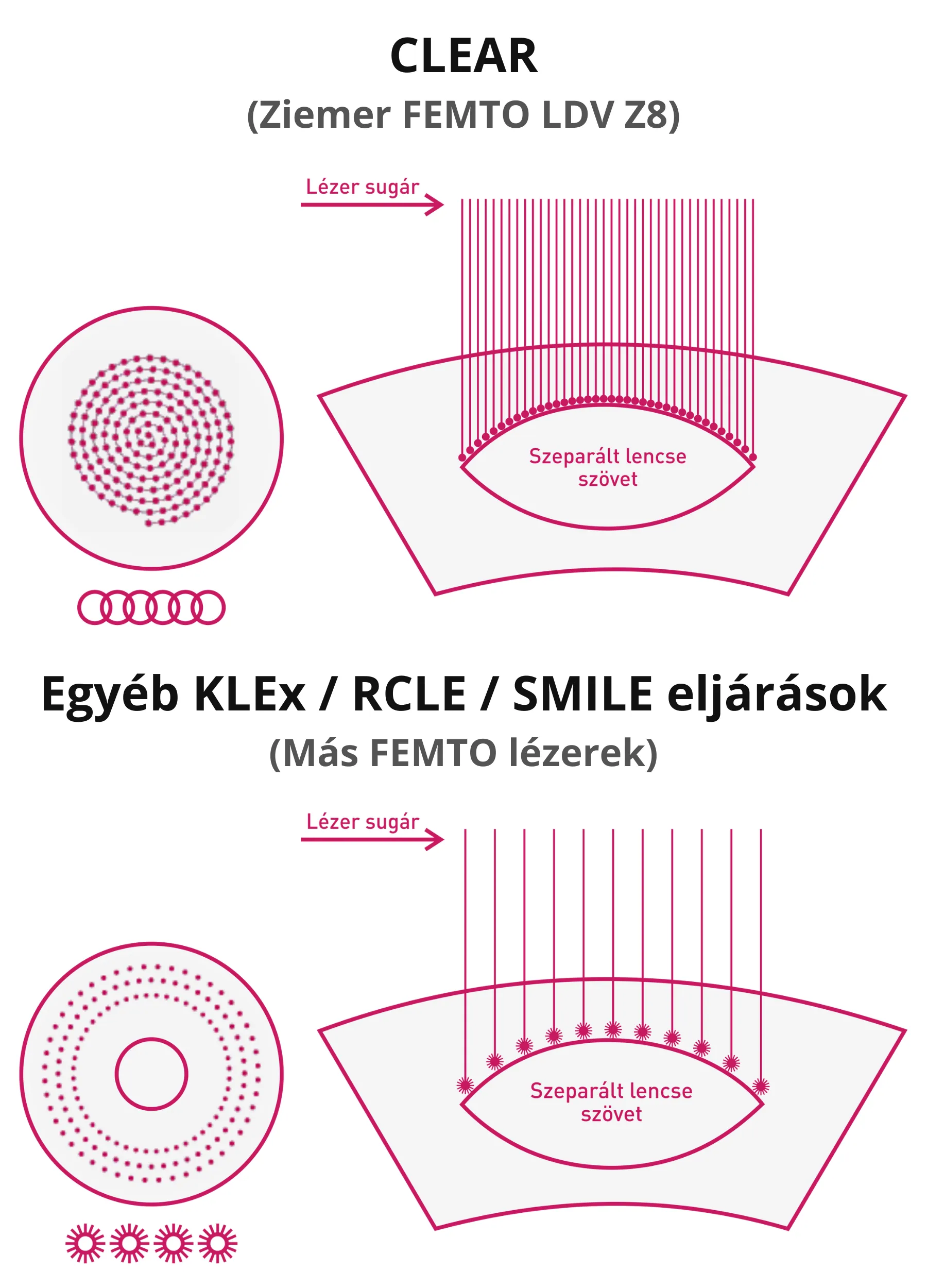 Lézeres szemműtét - lézeres látásjavítás - szaruhártya - stroma - ReLEx SMILE - SIKK Smartsight - KLEx - Clear - FEMTO - gázbuborék