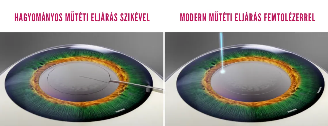 Hagyományos vs. modern FEMTO lézerrel asszisztált szürkehályog műtét - Lézeres szürkehályog műtét