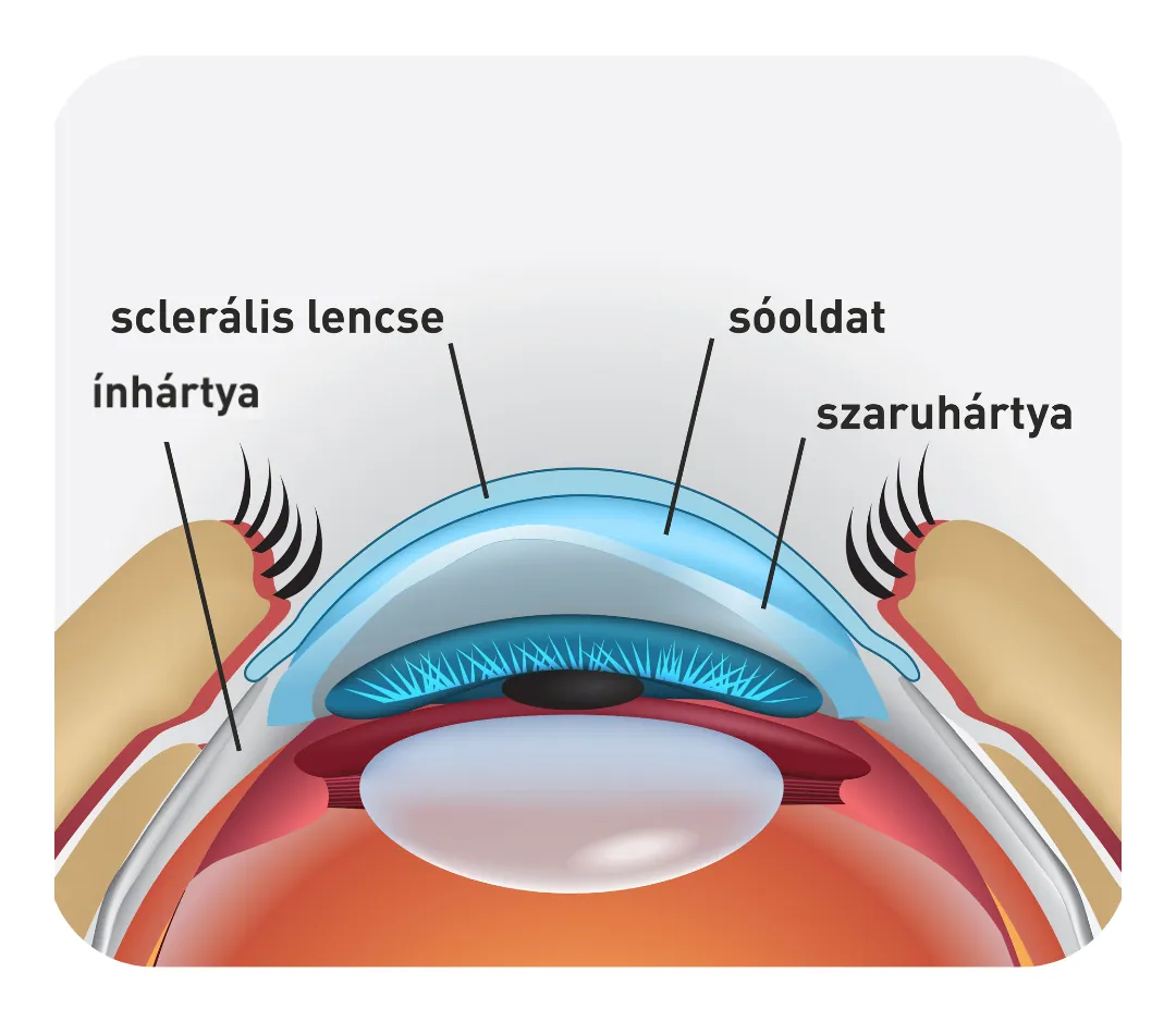 Sclerális kontaktlencse - keratoconus - szklerális kontaktlencse - Sclerális kagyló - látásjavítás